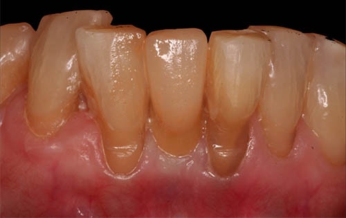 Implant Dentistry After Photo