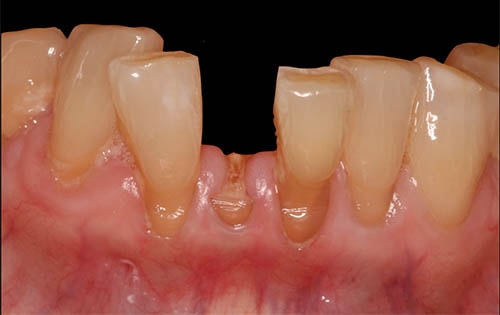 Implant Dentistry Before Photo