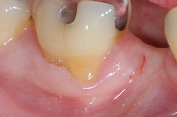 Implants Dentistry After Photo