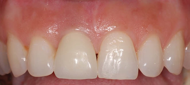 Implant Dentistry After Photo