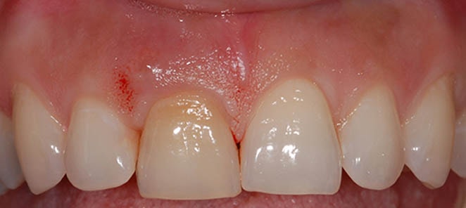 Implant Dentistry Before Photo
