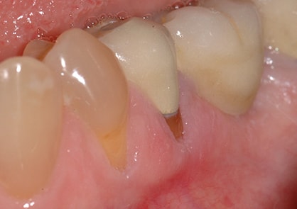 Full Mouth Reconstruction Dentistry Before Photo