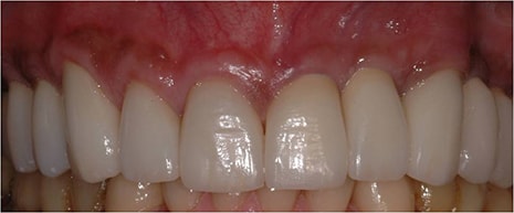 Implants Dentistry After Photo