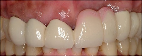 Implants Dentistry After Photo