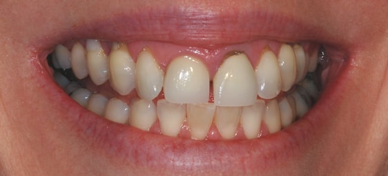 Full Mouth Reconstruction Dentistry Before Photo