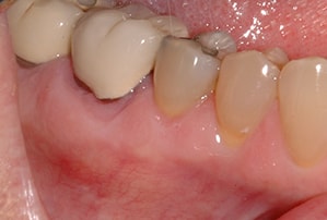 Full Mouth Reconstruction Dentistry After Photo