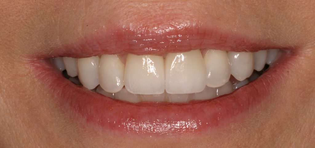 Full Mouth Reconstruction Dentistry After Photo