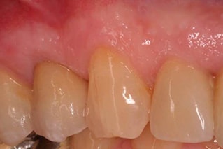Dental Crowns After Photo