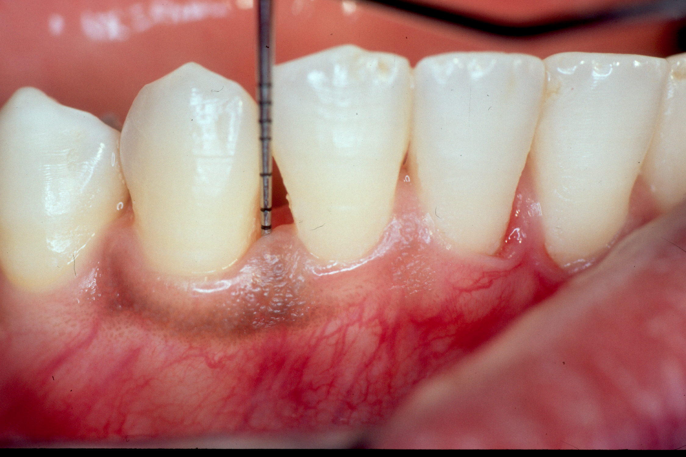 Implant Dentistry After Photo