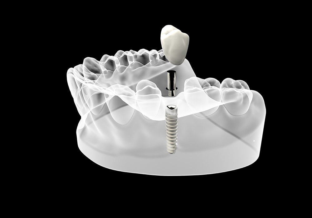 Cost of Dental Implants in West Palm Beach, FL
