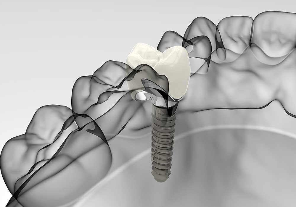 Cost of Dental Implants in West Palm Beach, FL