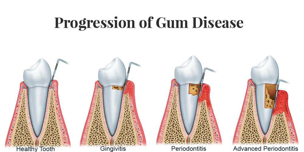 Treat Gum Disease in West Palm Beach, FL With LANAP® Laser Gum Surgery