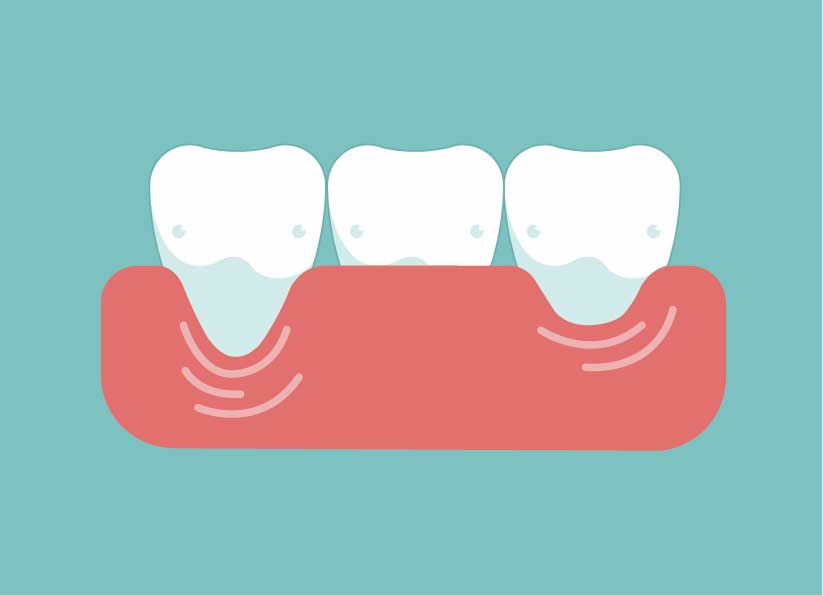 About Gum Recession in West Palm Beach, FL